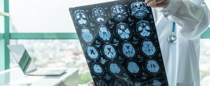 doctor holding up brain xray traumatic brain injury